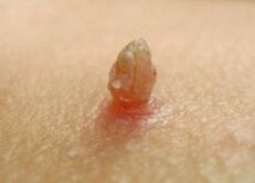 Keskin Papilloma