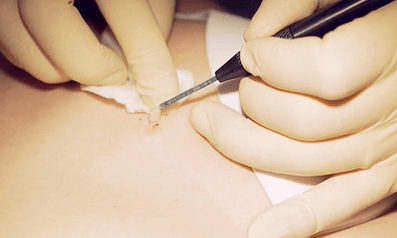 Plantar siğilin cerrahi olarak çıkarılması