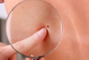 insan vücudunda papillomların ortaya çıkmasının nedenleri