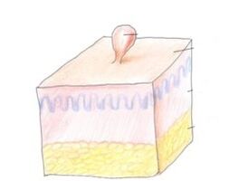 vücuttaki papillomadan nasıl kurtulurum