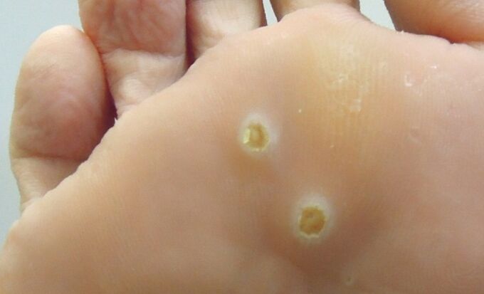 ayaktaki plantar papillomlar
