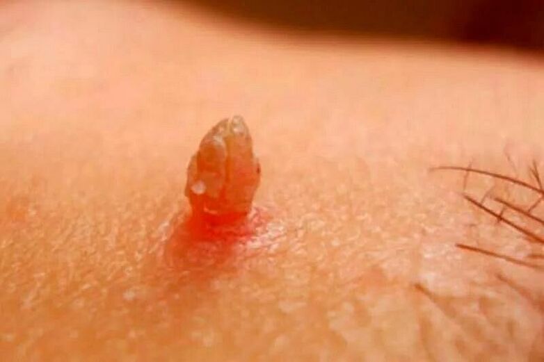 vücutta genital siğiller