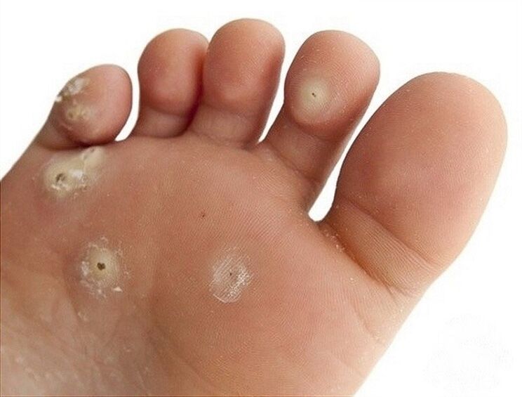 plantar siğil