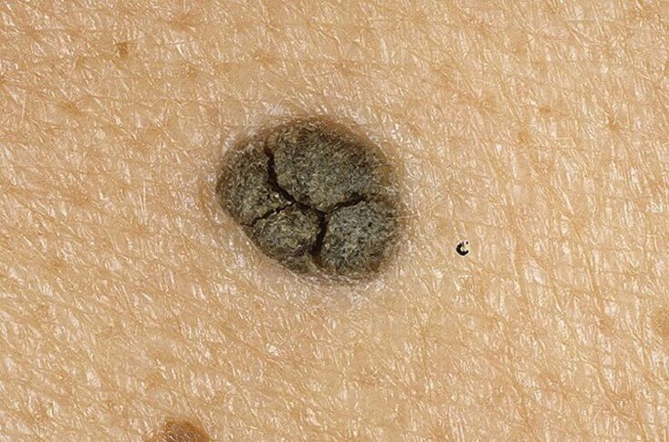 vücudun derisinde keratoma